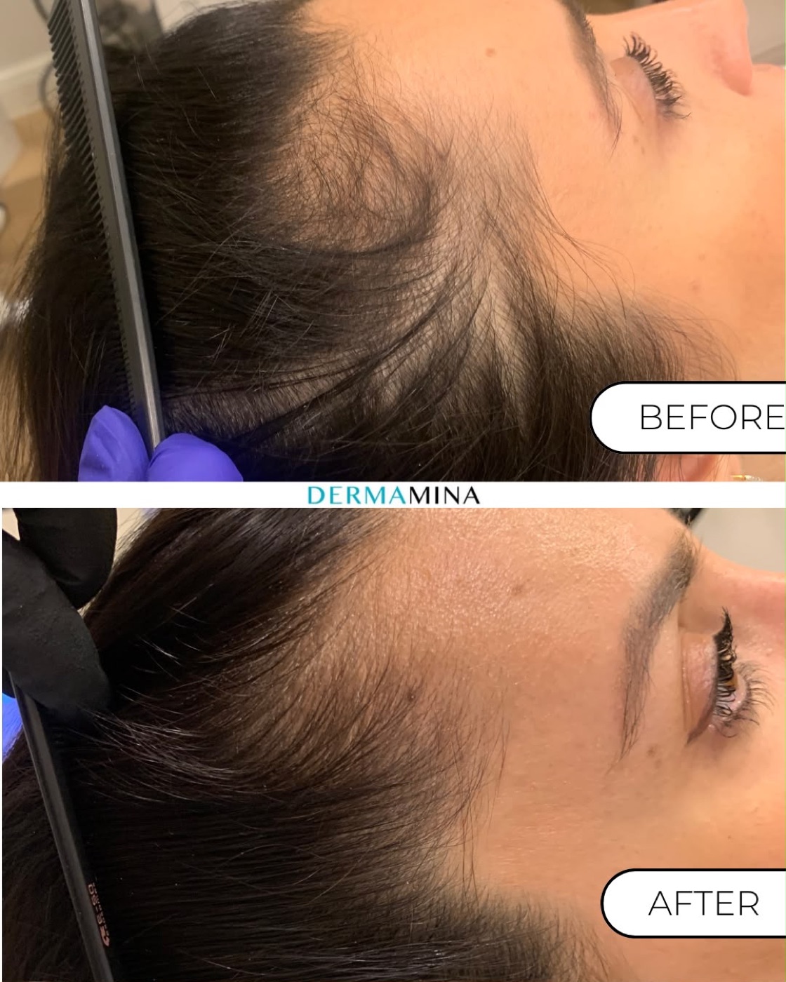 PRP hair loss before and after at Dermamina London, regrowth along a receding temple and hairline