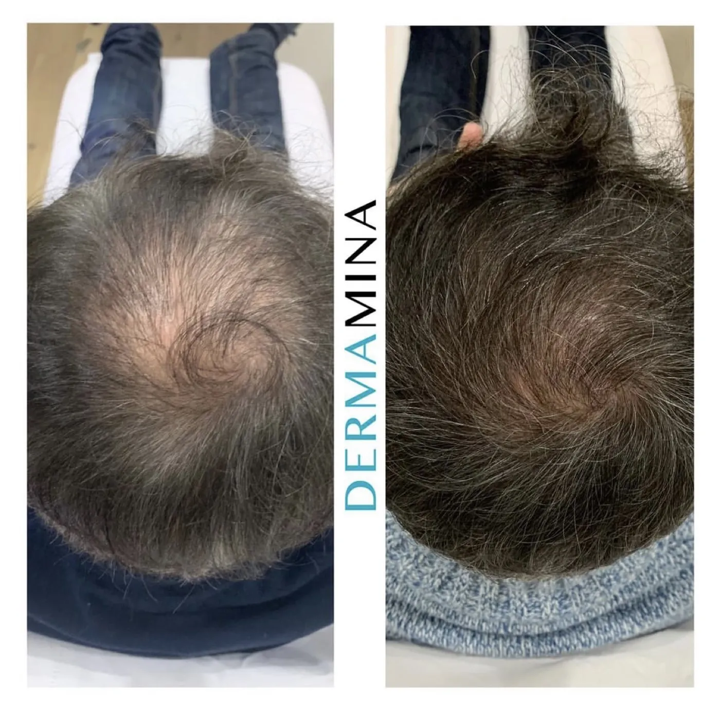 PRP hair loss before and after at Dermamina London, thicker coverage across a thinning male crown