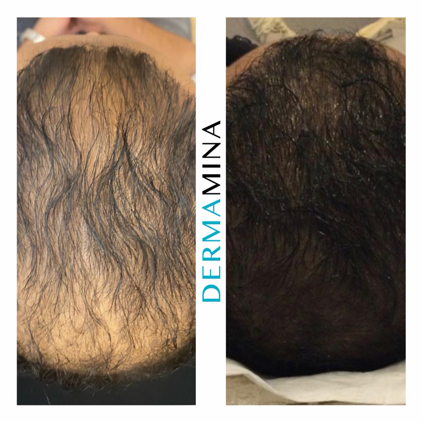 PRP hair loss before and after at Dermamina London, significant regrowth across the top of the scalp in male pattern hair loss