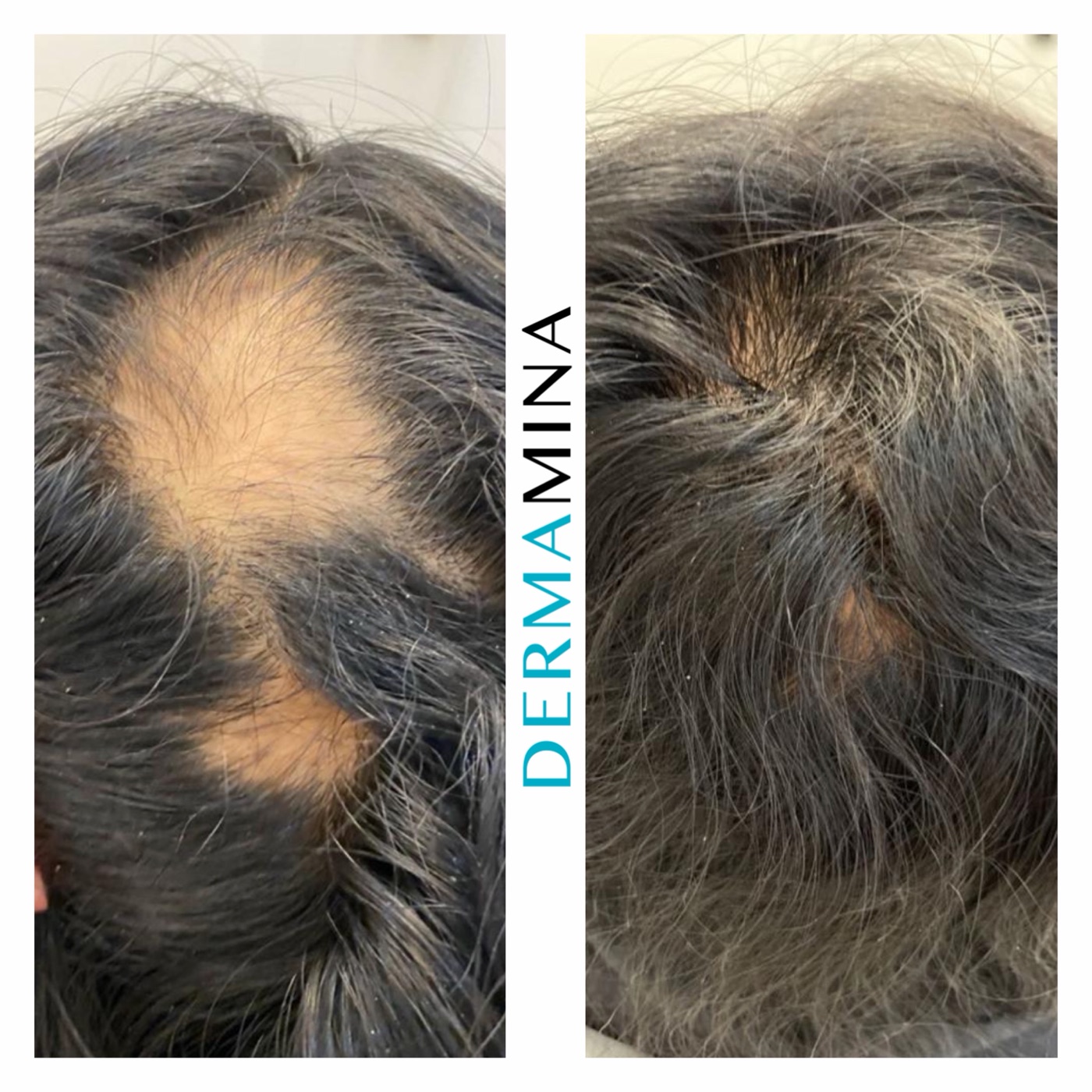 PRP hair loss before and after at Dermamina London, regrowth across bald patches from alopecia areata