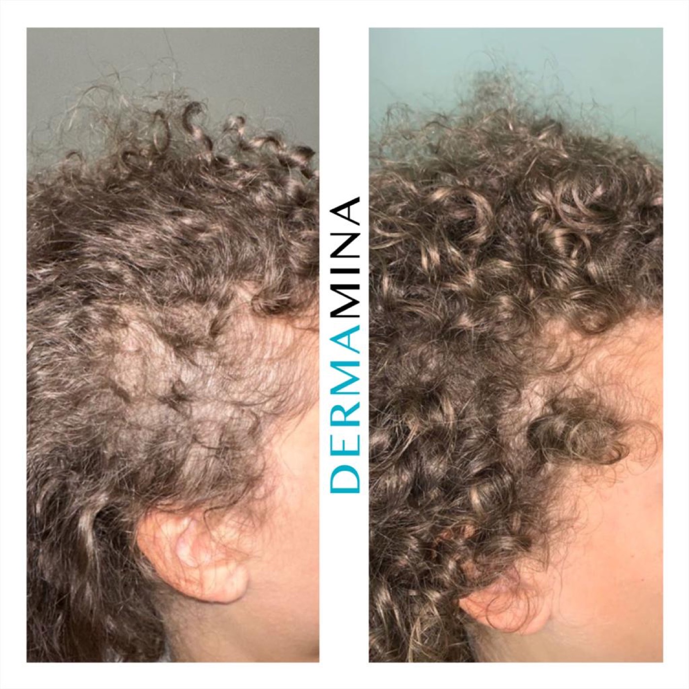 PRP hair loss before and after at Dermamina London, denser curly hair after treatment for diffuse thinning