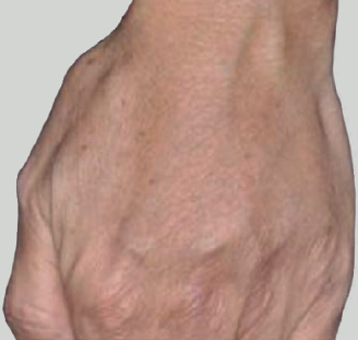 Hands Rejuvenation After