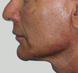 Jawline Enhancement After