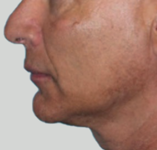 Jawline Enhancement Before