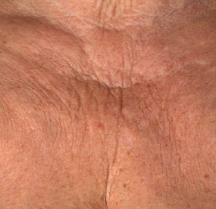 Décolleté Skin Quality Before