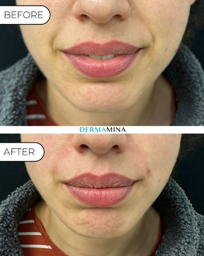 Smile lines treatment