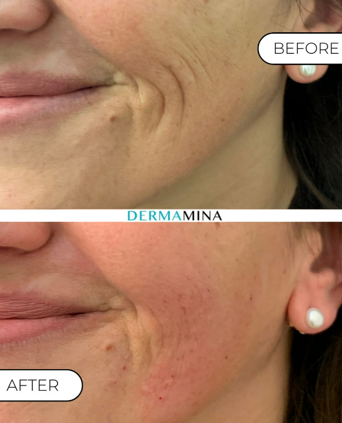 Before and After