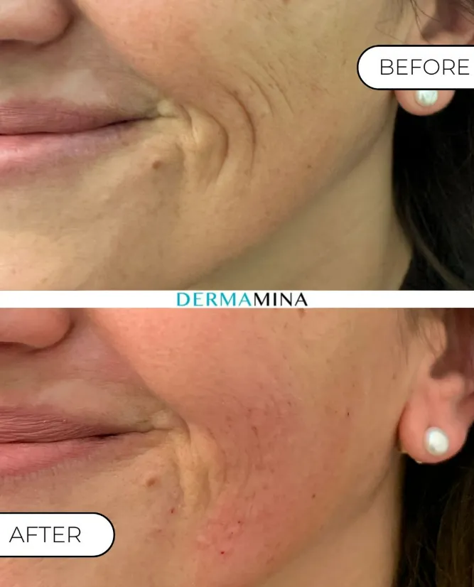 Smile Line Treatment