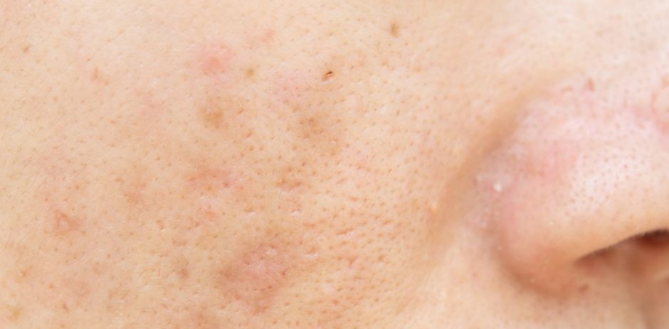 Spots