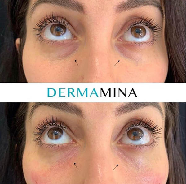 Before and after Tear Trough Under Eye