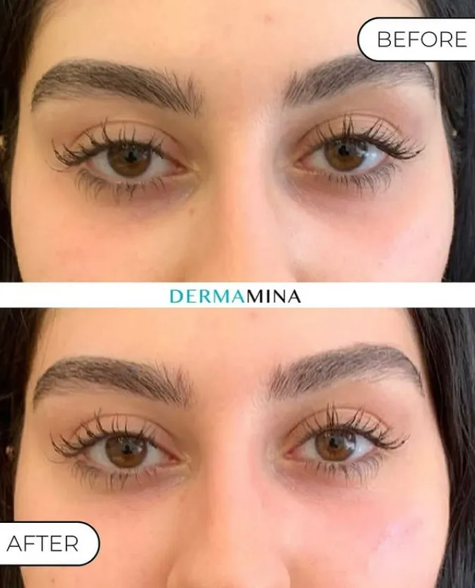 Tear Trough Under Eye Cost Price Guide
