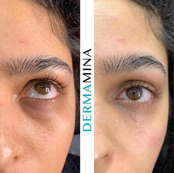 Before and after Tear Trough Under Eye
