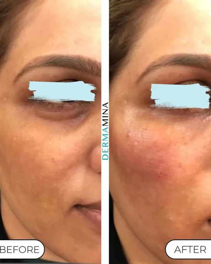 Tear Trough Under Eye How Long Results Last