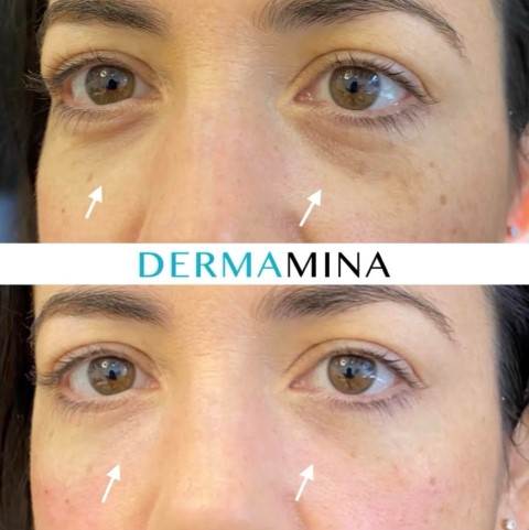 Before and after Tear Trough Under Eye