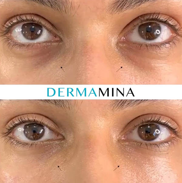 Before and after Tear Trough Under Eye