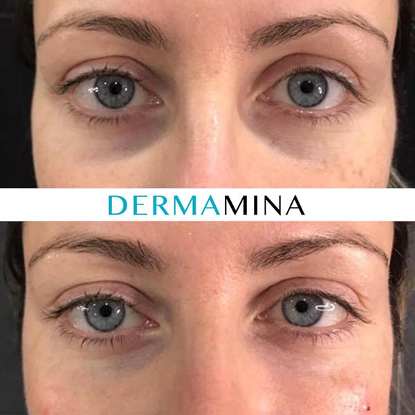 Before and after Tear Trough Under Eye