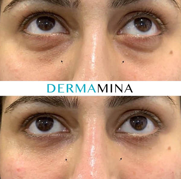 Before and after Tear Trough Under Eye