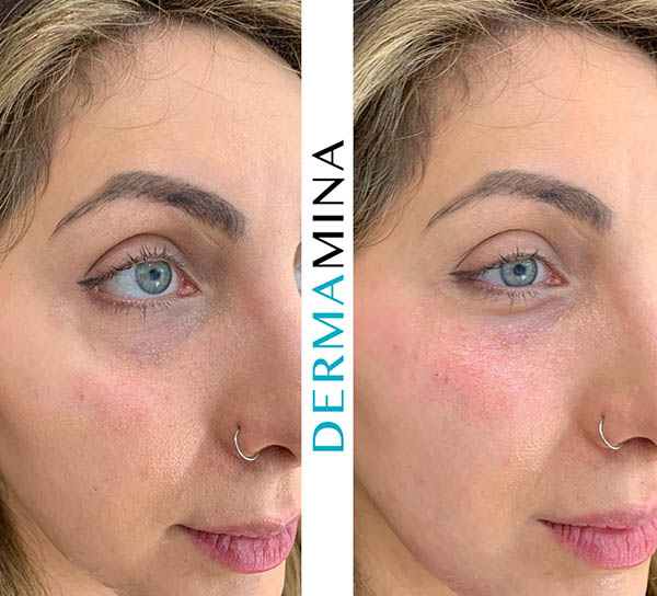 Before and after Tear Trough Under Eye