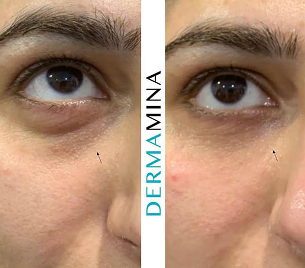 Before and after Tear Trough Under Eye