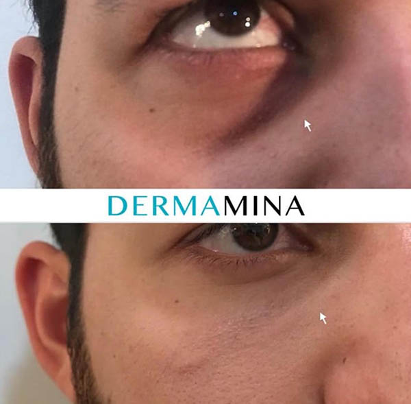 Before and after Tear Trough Under Eye