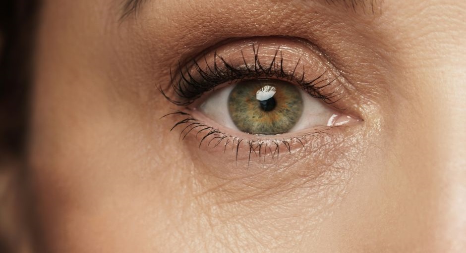 Under Eye Wrinkles