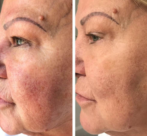 Before and after Prp Face Lift