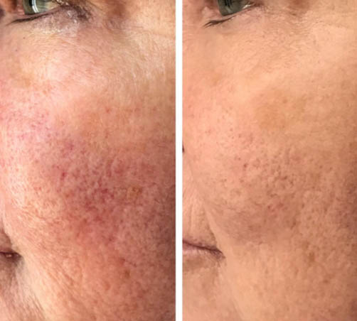 Before and after Prp Face Lift