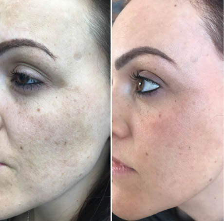 Before and after Prp Face Lift