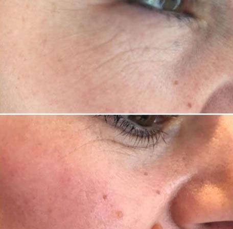Before and after Prp Face Lift