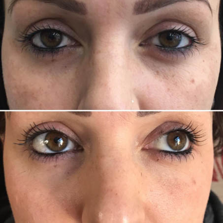 Before and after Prp Face Lift