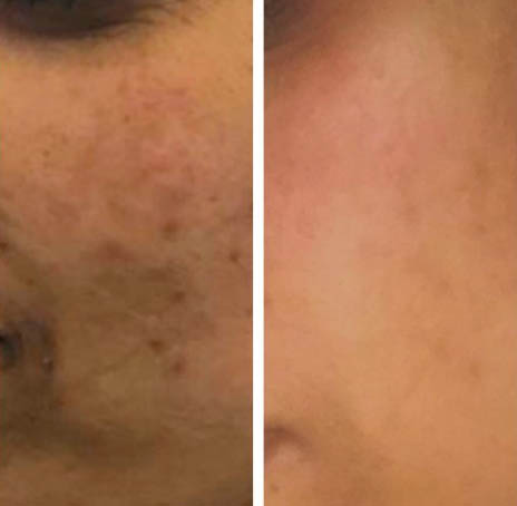 Before and after Prp Face Lift