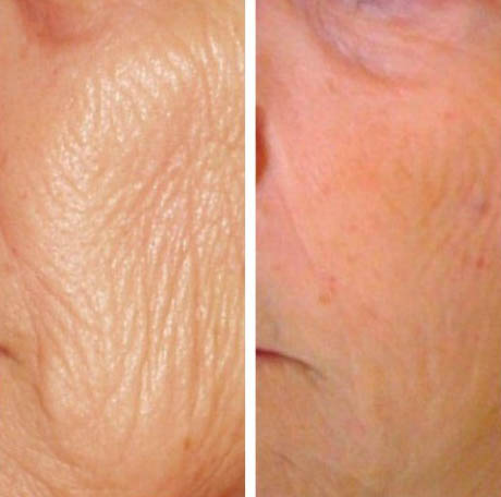 Before and after Prp Face Lift