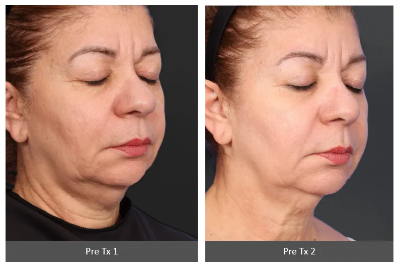 Before and After