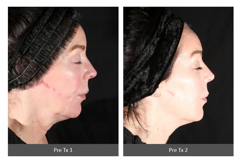 Before and After