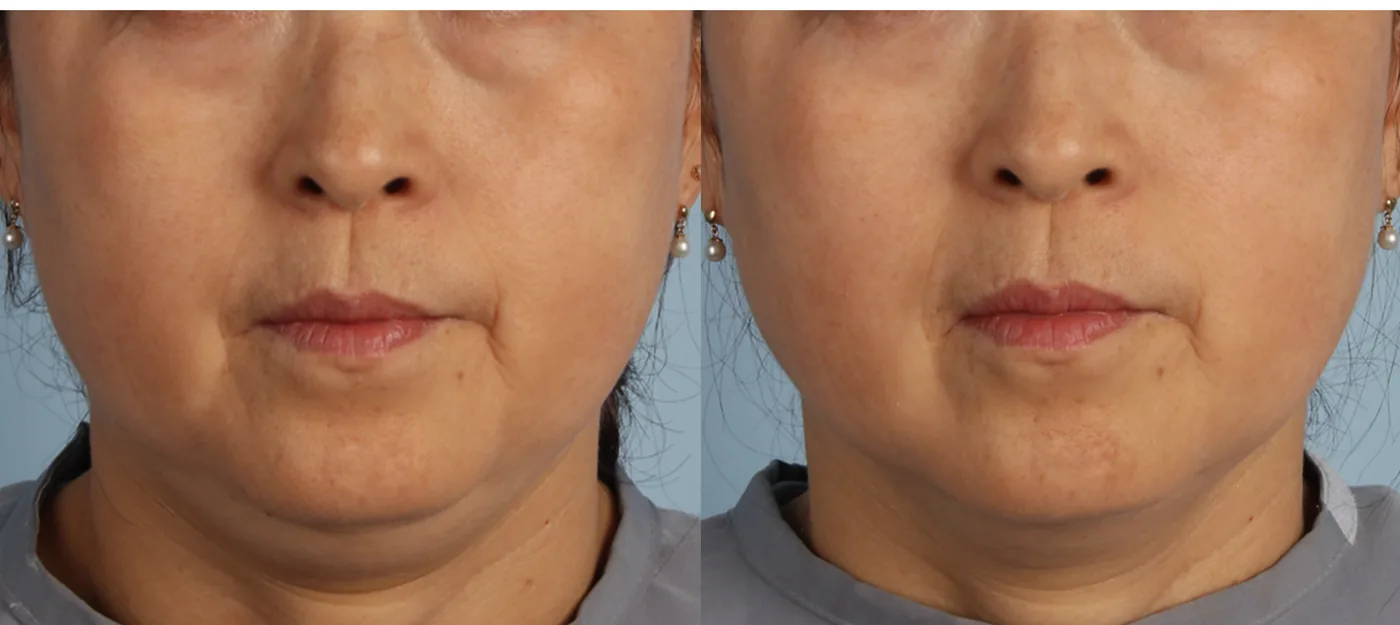 XERF before and after, front view of the lower face and under-chin area