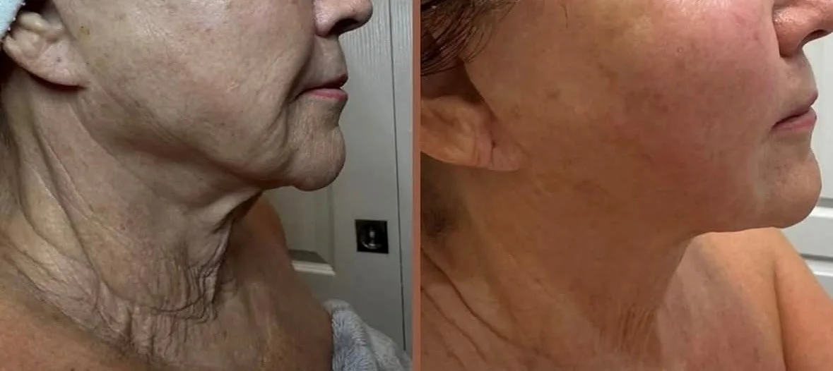 XERF before and after, smoother neck and firmer lower face in profile