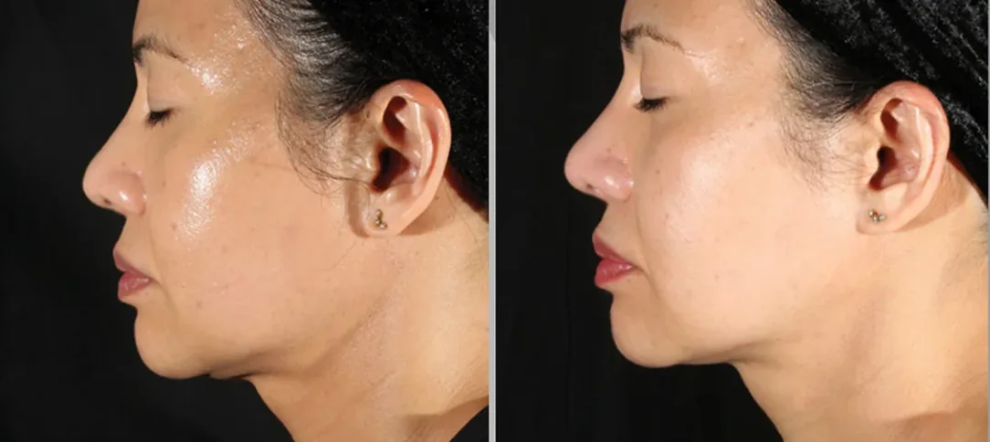 XERF before and after in profile after one treatment, tighter jawline and neck