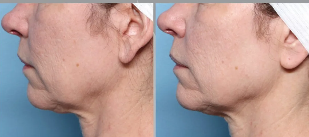 XERF before and after in profile, reduced submental fullness under the chin