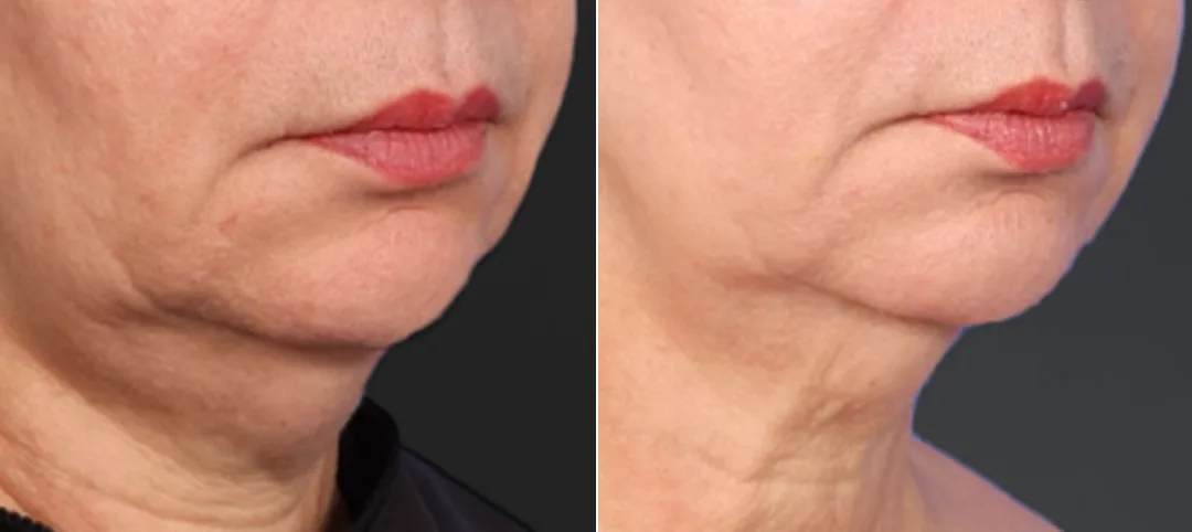 XERF before and after after two treatments, firmer cheek and jawline