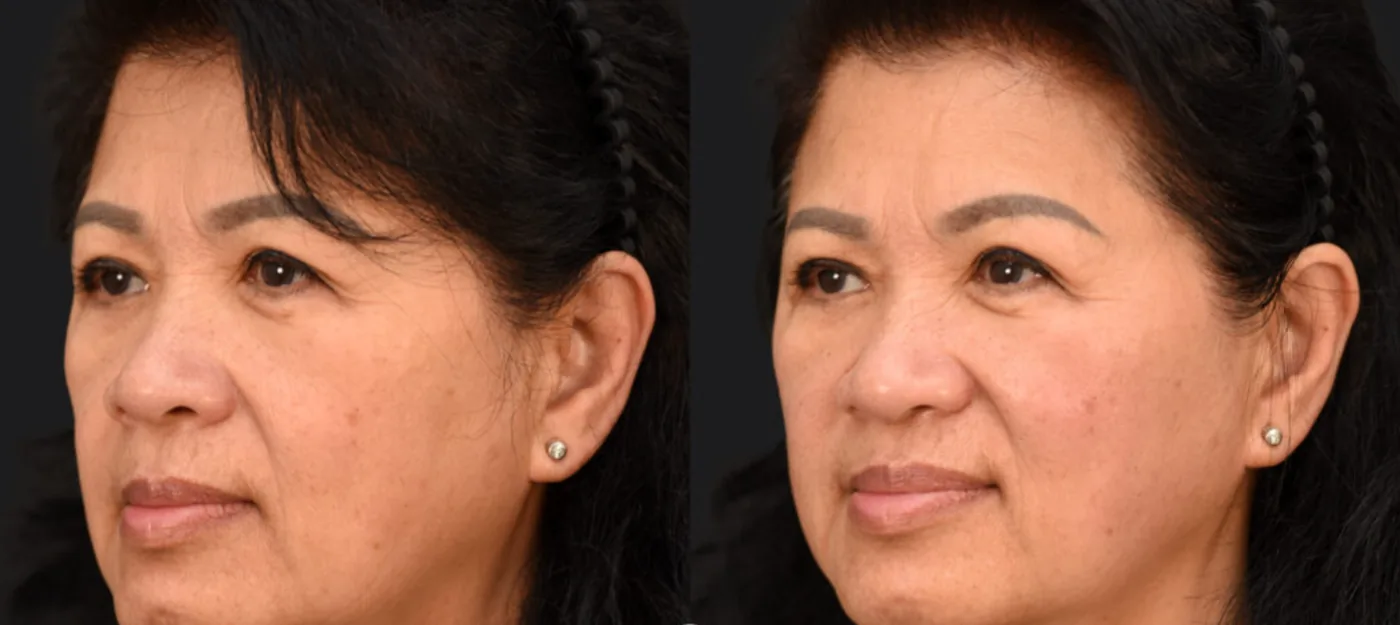 XERF before and after, lifted cheeks and jawline on a three-quarter view
