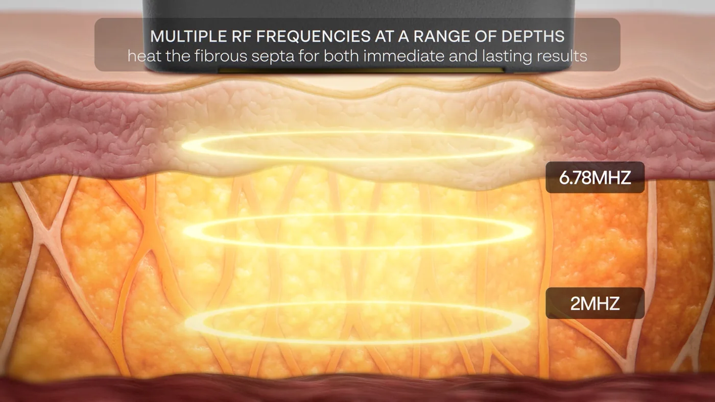 Cross-section diagram showing XERF 6.78 MHz and 2 MHz radiofrequency energy reaching different depths of skin