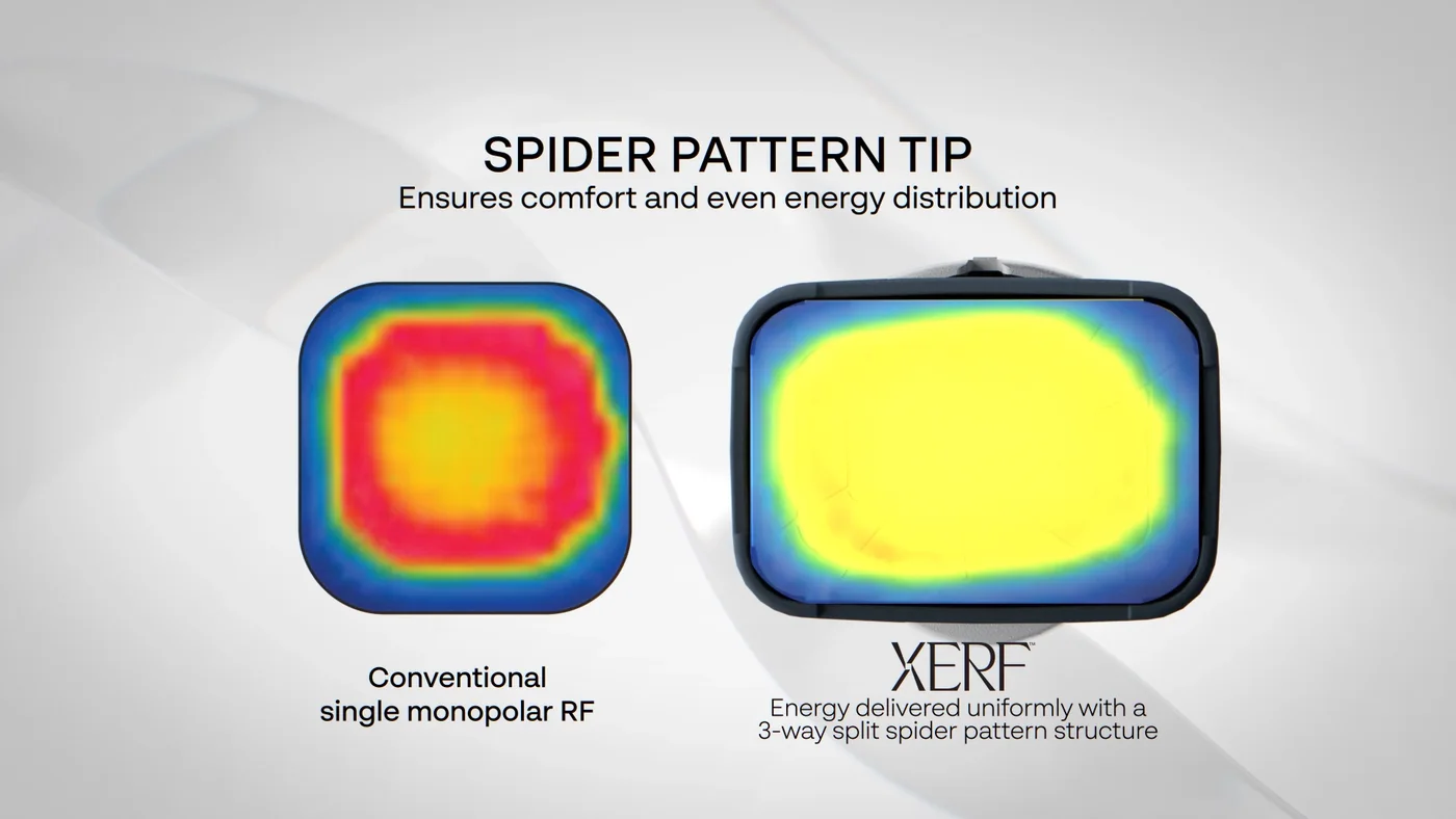 Thermal comparison of a conventional monopolar radiofrequency tip against the XERF spider pattern tip