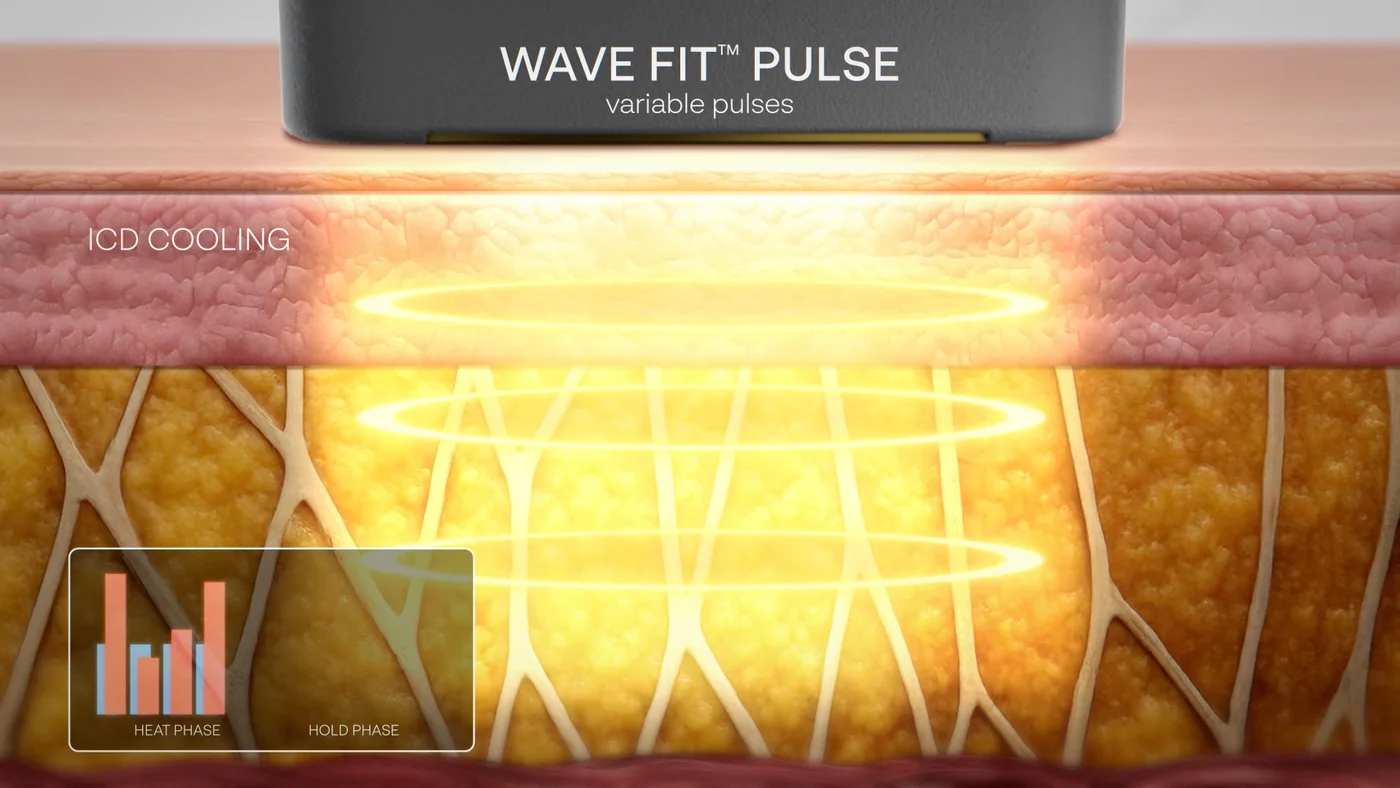 Diagram of the XERF Wave Fit pulse with integrated cryogen cooling at the skin surface